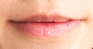 口角炎とは | 1分で知識王